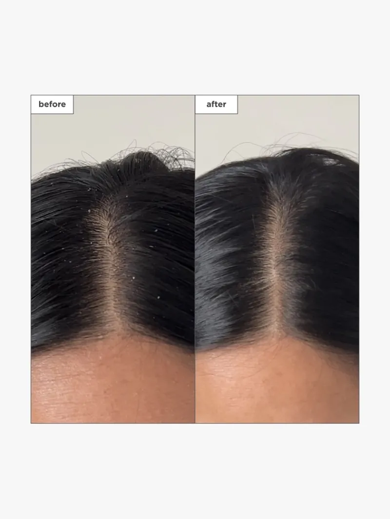 briogeo_scalp_revival_cha_3-3.webp Briogeo Scalp Revival™ Charcoal + Tea Tree Buildup Detox Spray | MECCA Hot