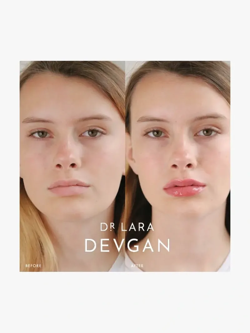 dr_lara_devgan_platinum_l_6.webp Dr. Lara Devgan Platinum Lip Plump | MECCA Best