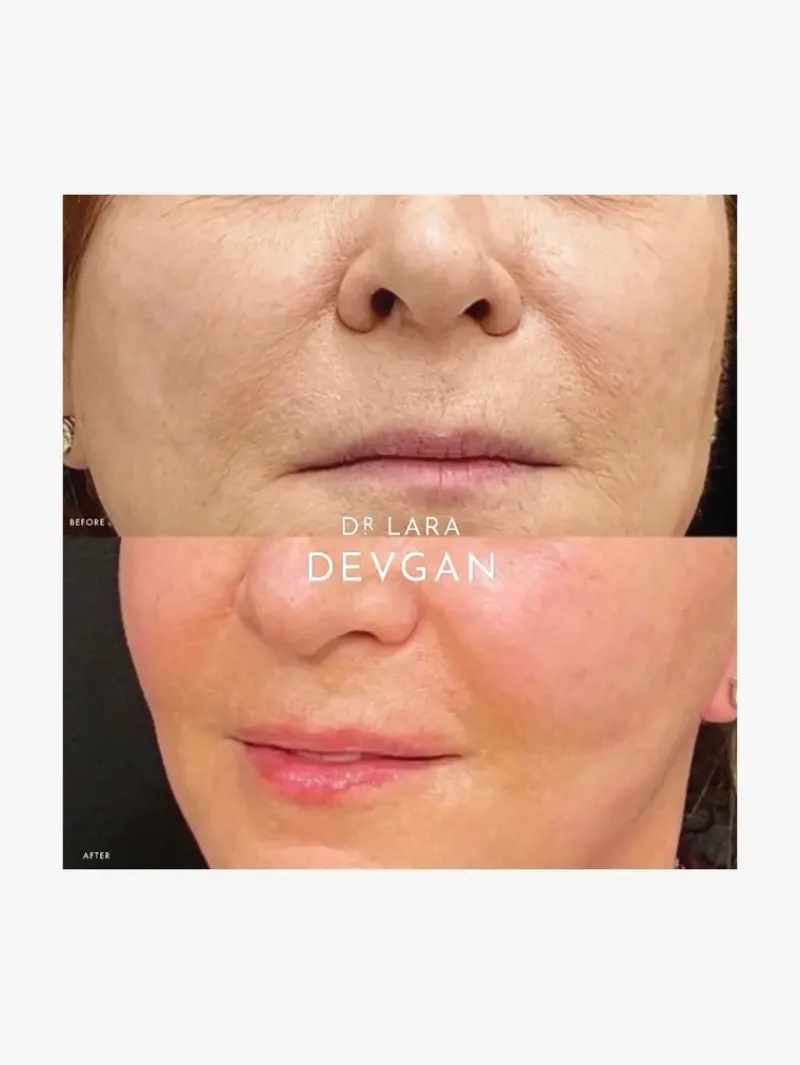 dr_lara_devgan_x_concentr_4-1.webp Dr. Lara Devgan 10x Concentration Retinol Bakuchiol Serum | MECCA Sale